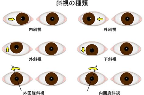 雙眼斜視|斜視及重影 複視 知多少